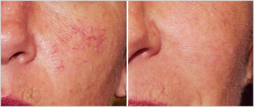 treatment facial thread for vein Laser